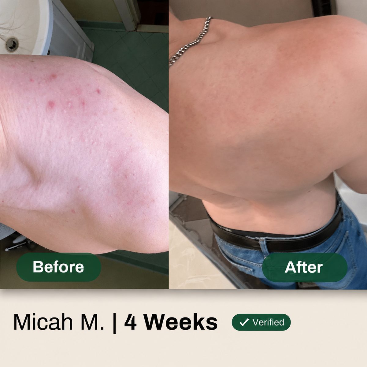 Before and after — shoulder acne cleared in 4 weeks